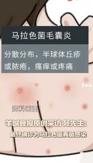 震惊！男子跑步后未擦汗感染马拉色菌，医生警告：这些习惯太危险！