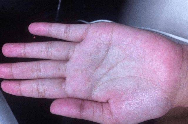 🔍震惊！看手就能知道肝好不好！医生不愿透露的5个关键信号