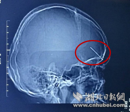 奇迹！女子大脑插6cm钢钉避开所有致命区域，医生直呼"医学奇迹"