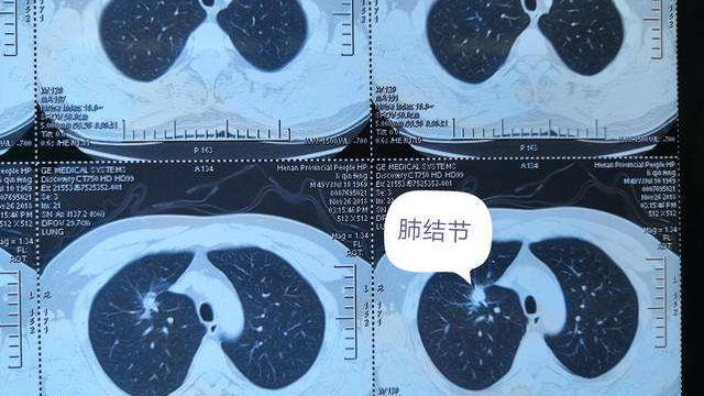 27岁女子肺结节没在意1年后确诊肺癌：年轻不是免死金牌，这些信号千万别忽视！